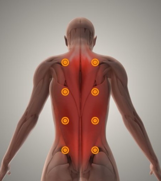 Μυοπεριτονιακό Σύνδρομο